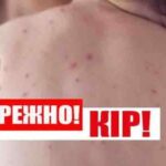 Ще двадцять мешканців Кропивницького захворіли на кір