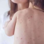 У МОЗ заявили про новий спалах кору