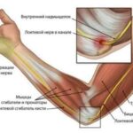Тендиніт сухожилля – опис, симптоми і лікування
