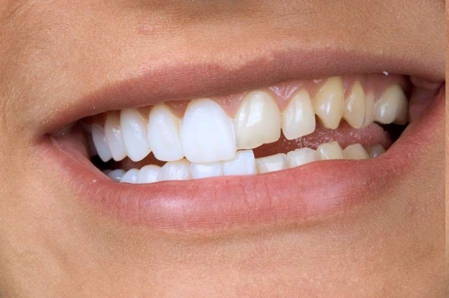 Какую коронку лучше установить на передние зубы?