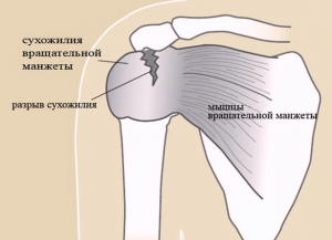 Повреждение ротаторной манжеты плеча – симптомы и лечение