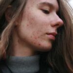 Позбавляємось від прищів за допомогою харчування