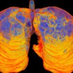 AstraZeneca показала високі результати експериментального лікування ХОЗЛ