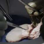 Люди з пересадженими свинячими органами отримують нове життя